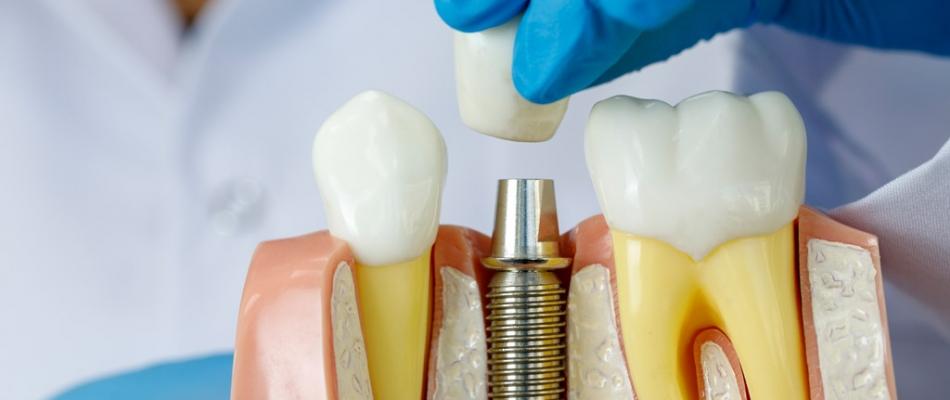 Dental Implant